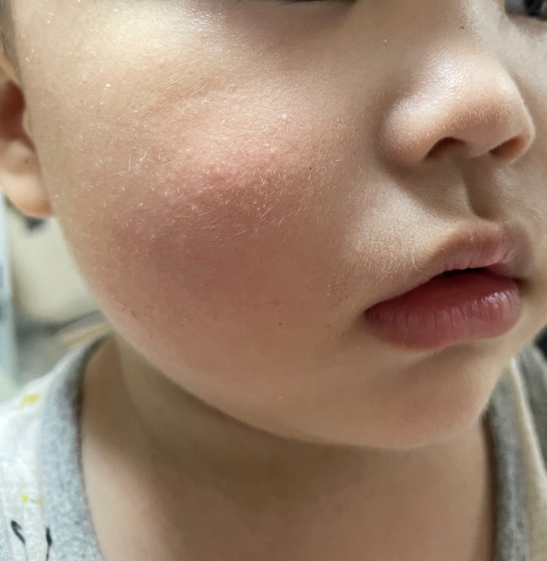 毛孔性苔癬 もうこうせいたいせん 集中治療：施術メニュー：マ行銀座ケイスキンクリニック東京・銀座の美容皮膚科・美容医療・アンチエイジング・若返り