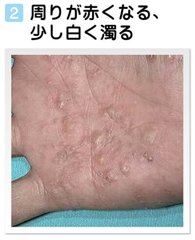 汗疹 あせも が厳しい季節。なるべく早めに汗を洗い流して保湿！あなたの肌を若返らせたい！形成外科医の独り言です