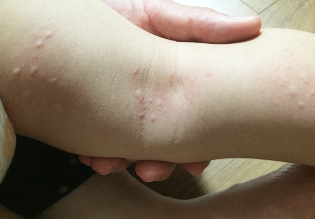 蕁麻疹 じんましん埼玉県皮膚科医会