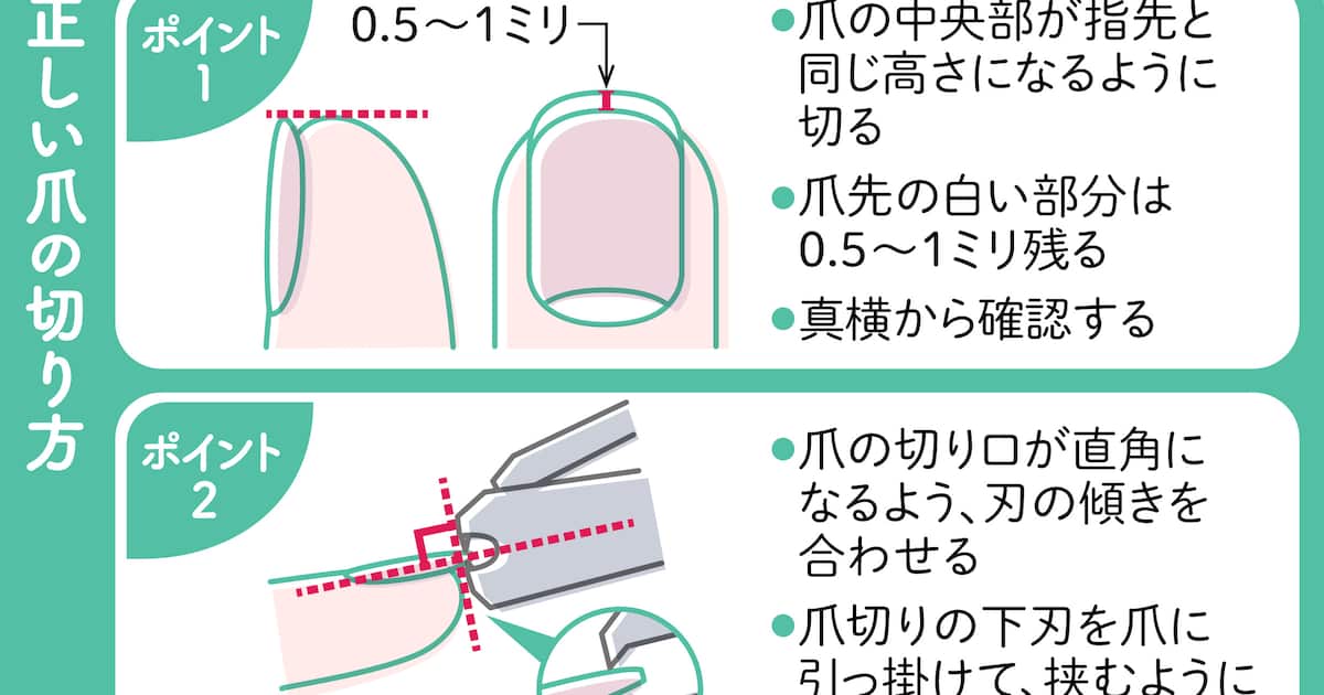 爪を短く切りすぎた！痛い！深爪のリスクや早く伸ばす方法を解説専門医と学ぶ 巻き爪・陥入爪治療の相談室