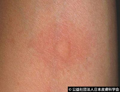 虫刺され野田市 小児科 千葉県 こどもの花粉症 こどもの漢方 喘息 アトピー性皮膚炎 アレルギー 結節性痒疹 たんぽぽこどもクリニック