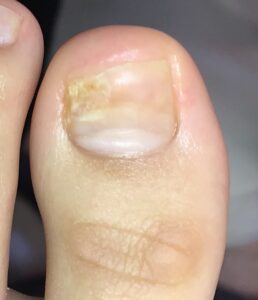 爪の病気・爪の異常 手足の爪画像病院で治せなかった爪の病気、自分で治せなかった爪を健康にするメディカルネイルサロン実績30年のバハネイル