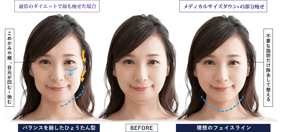 頬肉を落とす方法とは？筋トレやマッサージ、おすすめの美容整形も解説EMMO FACE CLINIC大宮 東京三田 大阪梅田の美容外科・美容皮膚科