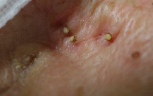 陰部 デリケートゾーン に粉瘤ができる原因と特に女性に多い理由 - 北海道皮膚のできものと粉瘤クリニック古林形成外科札幌院中央区大通にて皮膚悩みを土日祝も対応