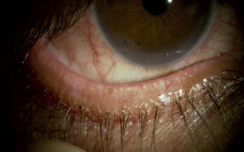 福岡市博多区で霰粒腫・ものもらいの治療ならよしやま眼科切開によるものもらい治療に対応