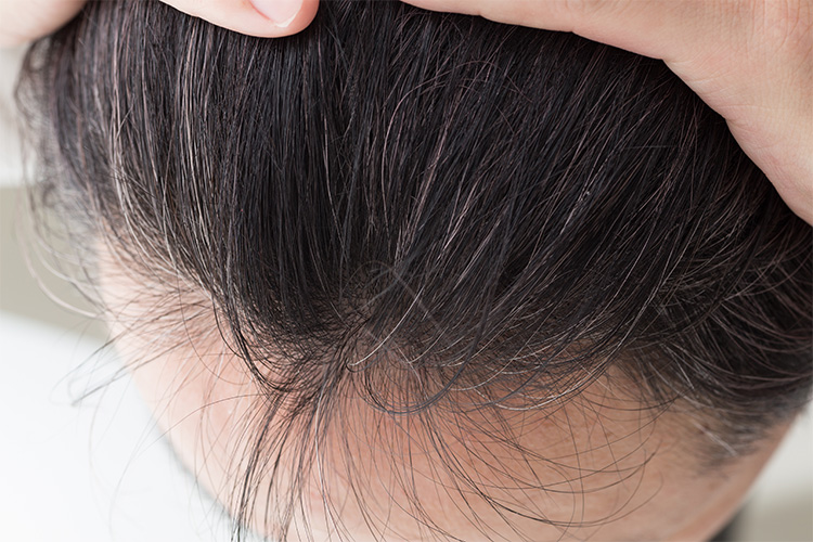 そのおでこのニキビが治らないのはヘアケアの習慣が原因かも！？ノンジアミンカラーなど髪と頭皮 の悩み解決を得意とする大阪寝屋川香里園の美容師あっくんのヘアケアブログ