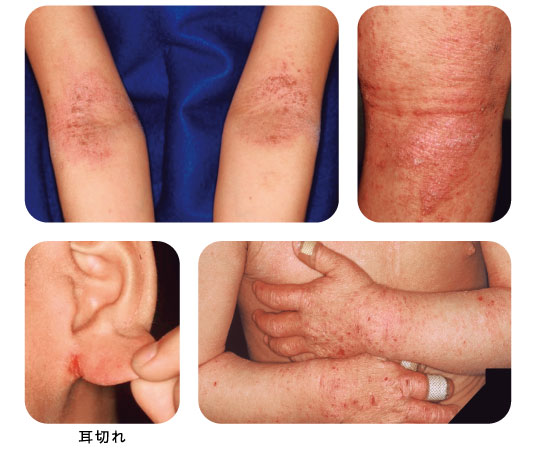 貨幣状湿疹、うっ滞性皮膚炎、静脈瘤・熊本県の病院・医院 水前寺皮フ科医院