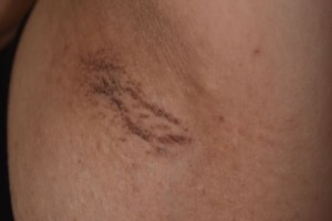 脇のブツブツはどうしてできる？原因と脇を脱毛するメリットを紹介mismos ミスモス