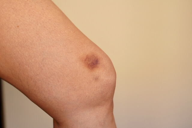 青あざができやすいのはなぜ？ぶつけていないのにできる原因や子どもの生まれつきの青あざも紹介