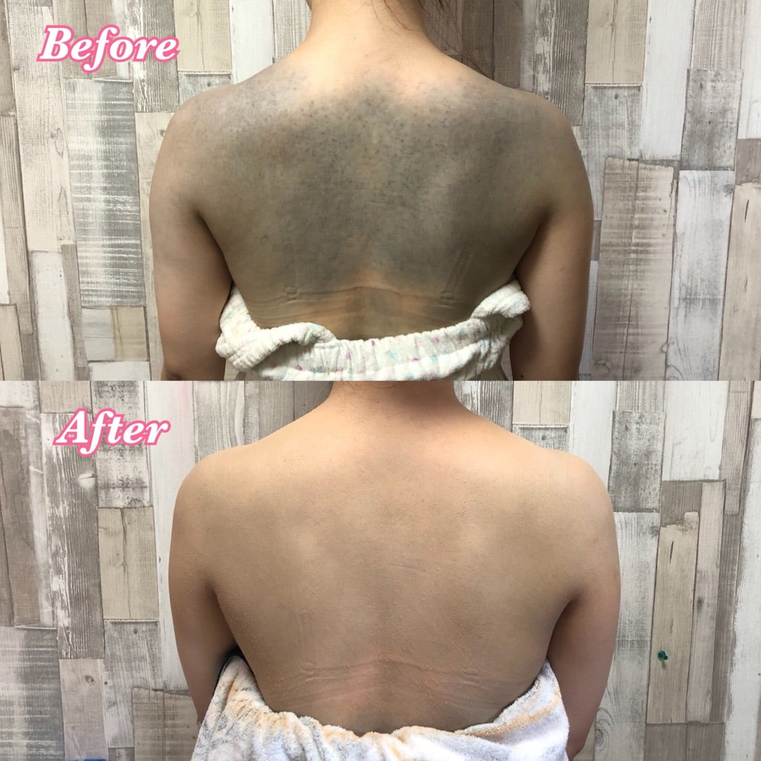 蒙古斑 青あざひびきの皮ふ科 北九州市八幡西区学研都市ひびきのにある皮膚科