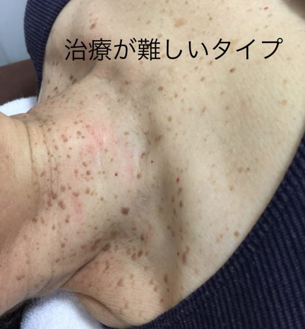 イボ・水イボの種類-原因と治療法富田るり子皮膚科クリニック