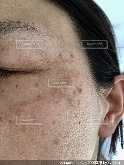 シミ シミがない人の共通点