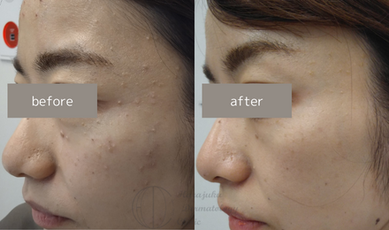 妊娠中にできてしまった首いぼの原因は？イボの治し方6選Be a mother