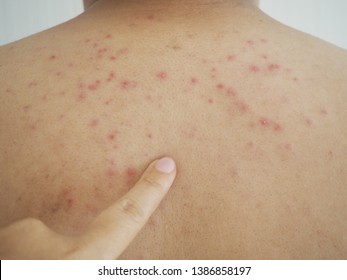 あせも 汗疹 かんしん こばとも皮膚科栄駅 名古屋市栄区 徒歩2分