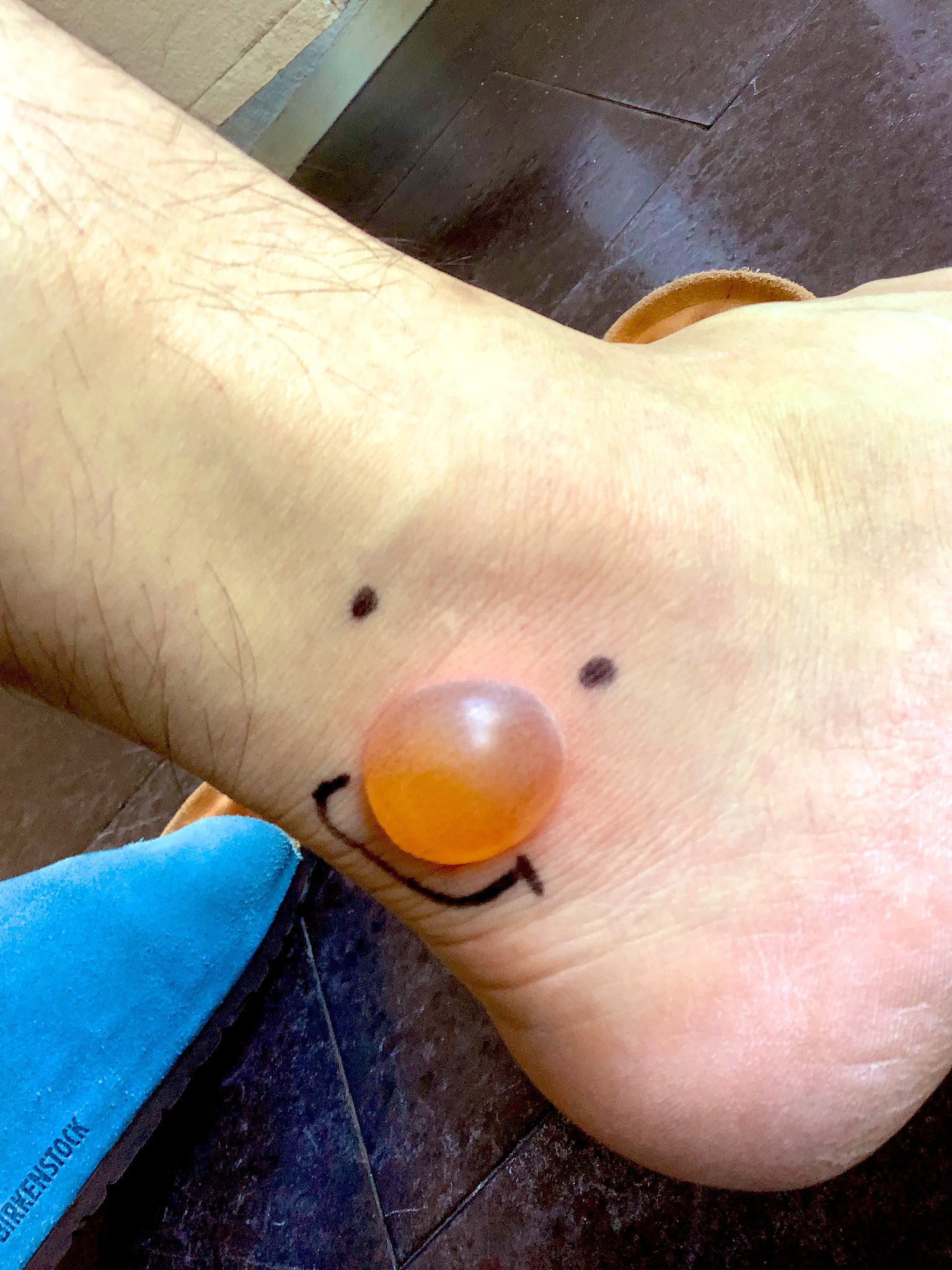 症例画像 虫刺されの症状・対処法 ひどい腫れや痒みも皮膚・爪・髪の病気All About