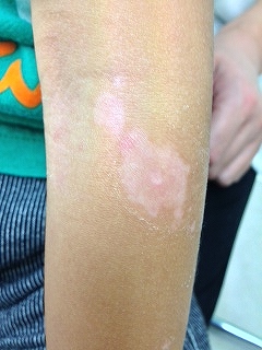 シミ取りレーザー後の色素脱失？シミ取り・肝斑・毛穴治療 Qスイッチレーザー の治療への不安 痛み・失敗・副作用