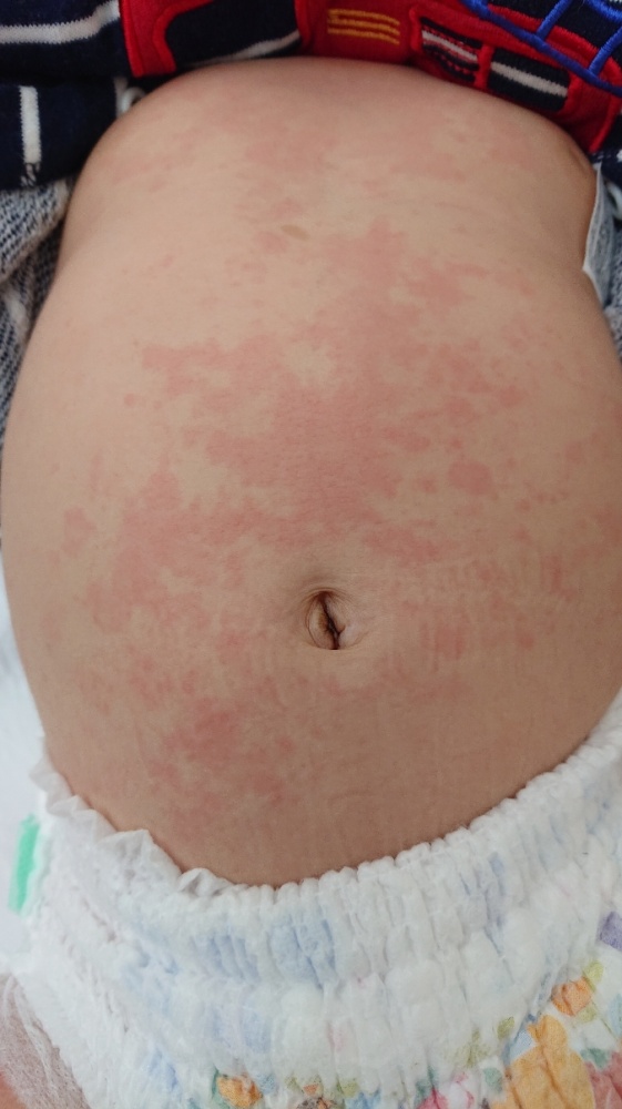伝染性紅斑 リンゴ病Erythema infectiosum– 感染症 - 神戸きしだクリニック 神戸市中央区