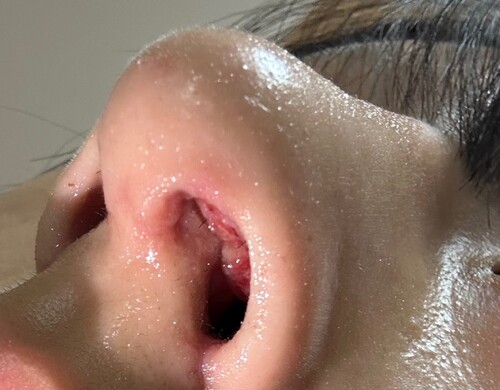 鼻の痛み尼崎、西宮の耳鼻科 皮膚科内科 尾上医院