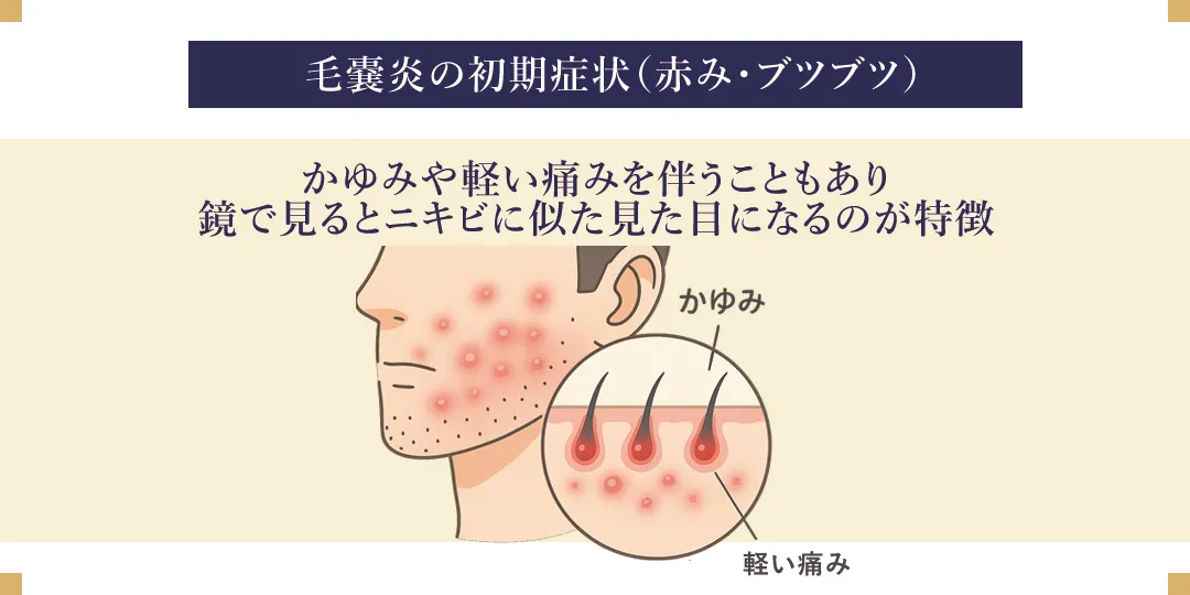 皮膚科医監修 毛嚢炎ができる原因と早く治す方法を解説
