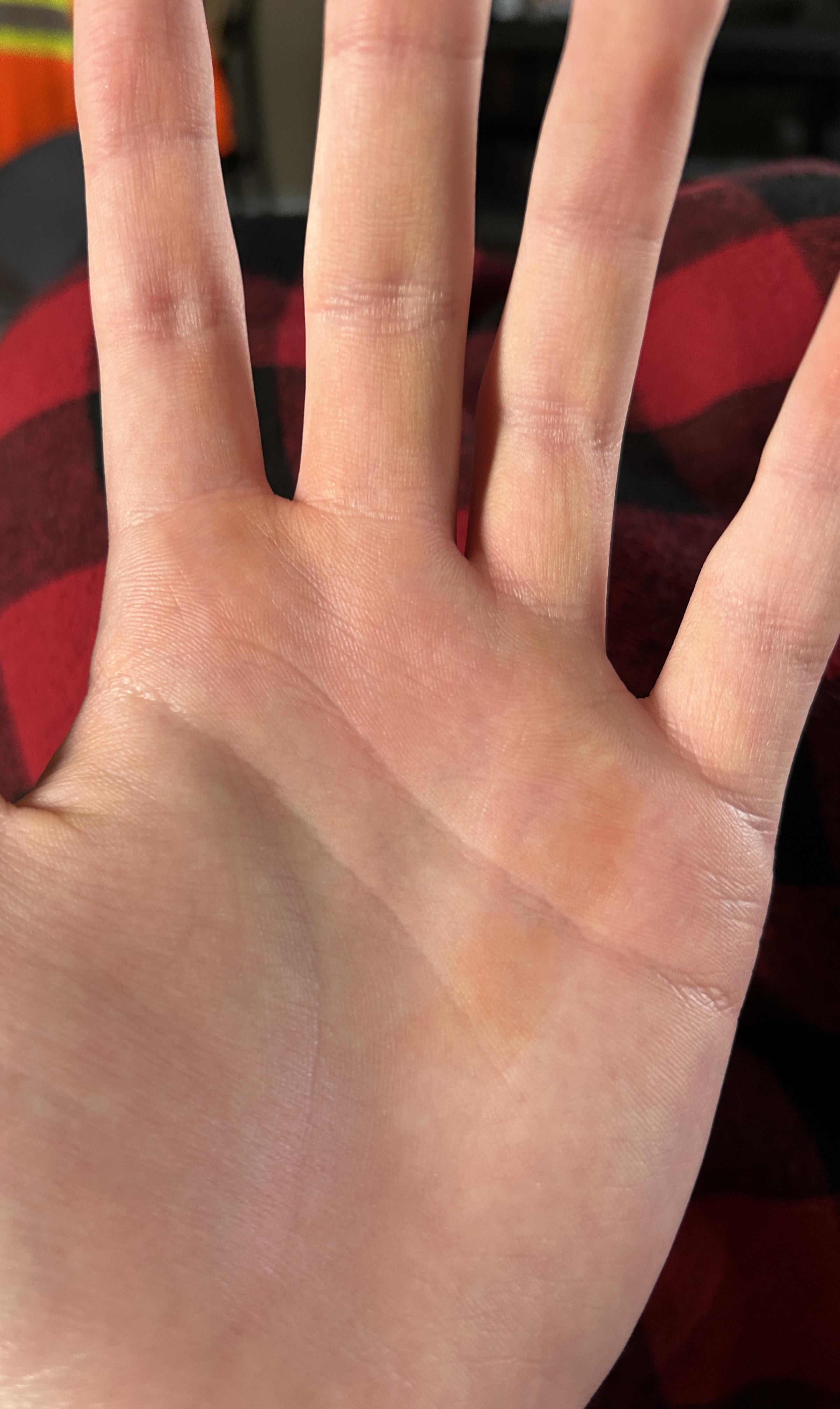 今日手を見たらここがオレンジ色になっていたんですがなんでですか？- Yahoo!知恵袋