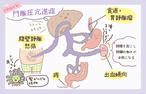 合併症別の食事療法食べるエーザイの肝疾患サポートサイト～つなぐ支えあう”あなたらしさ”を～