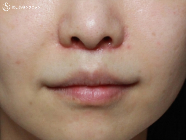 鼻のブツブツの写真・画像素材-Snapmart スナップマート