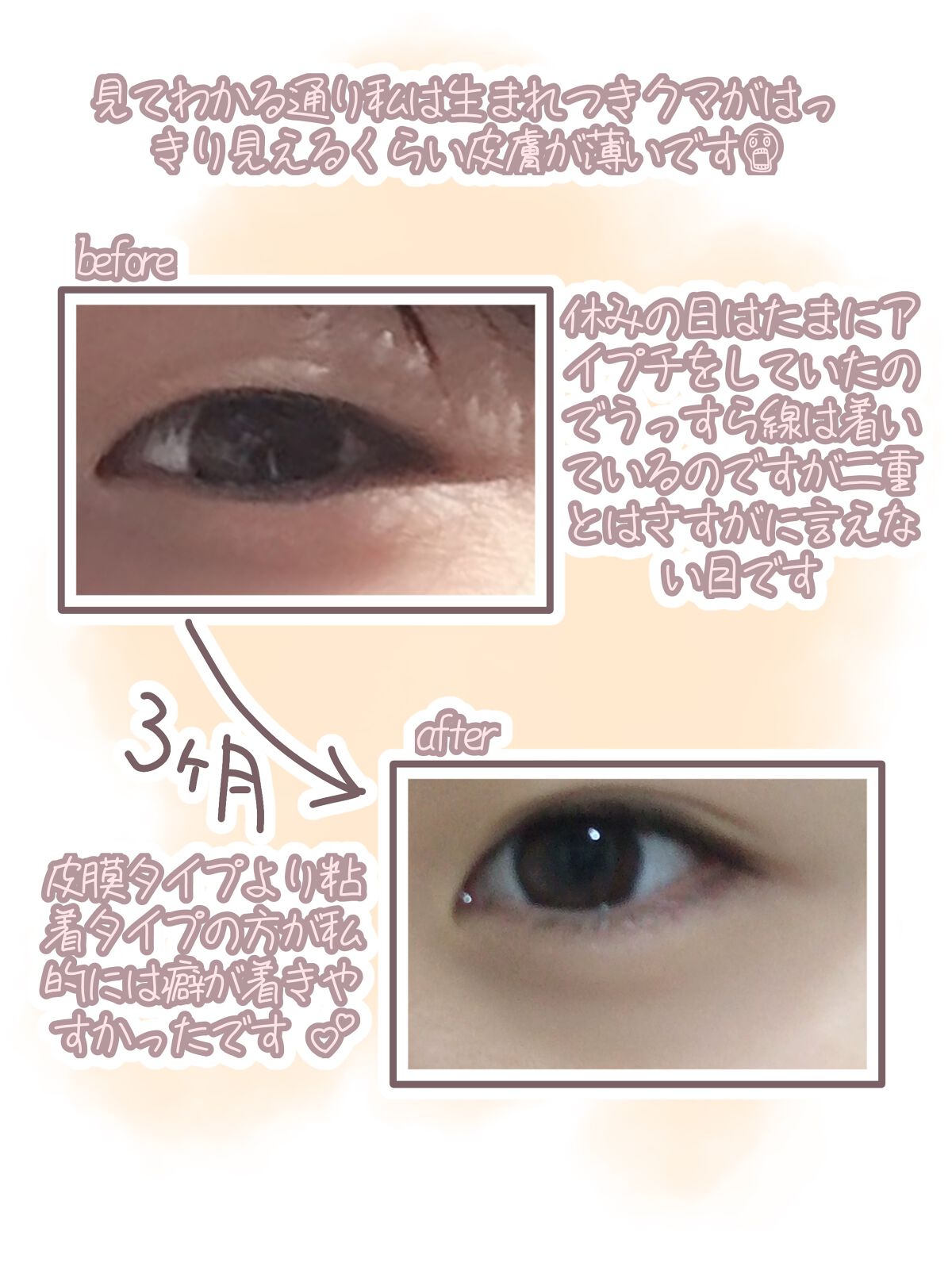 三重まぶたは遺伝？生まれつき？赤ちゃんからまぶたはどう変わる