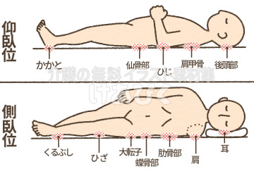 褥瘡 床ずれ の原因とはメディカルノート