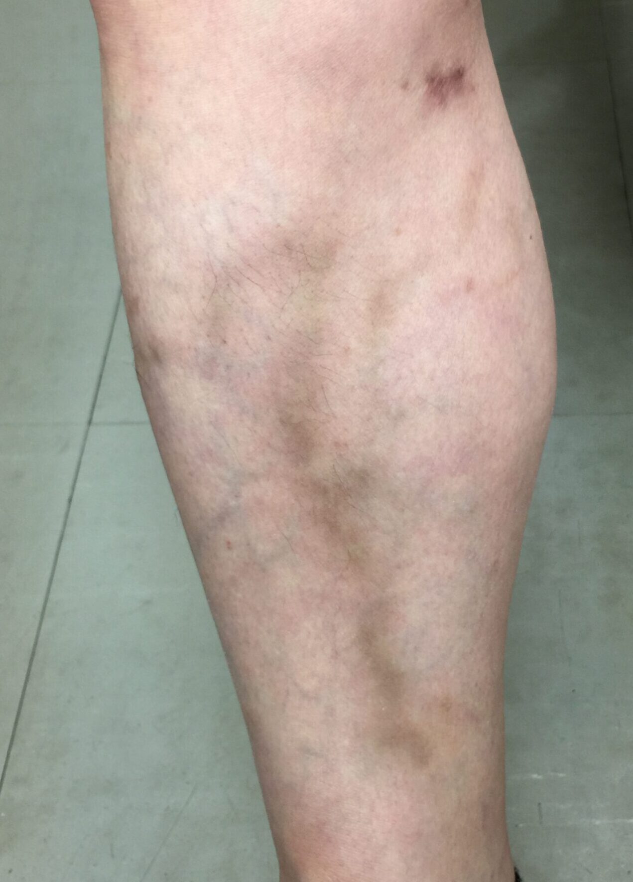 ニキビ跡の色素沈着はレーザー治療で消すニキビ治療・ニキビ跡治療の東京イセアクリニック