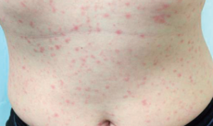 梅毒治療開始後に皮疹・湿疹がでたら渋谷・五反田・中野性病検査の感染症内科カラダ内科クリニック