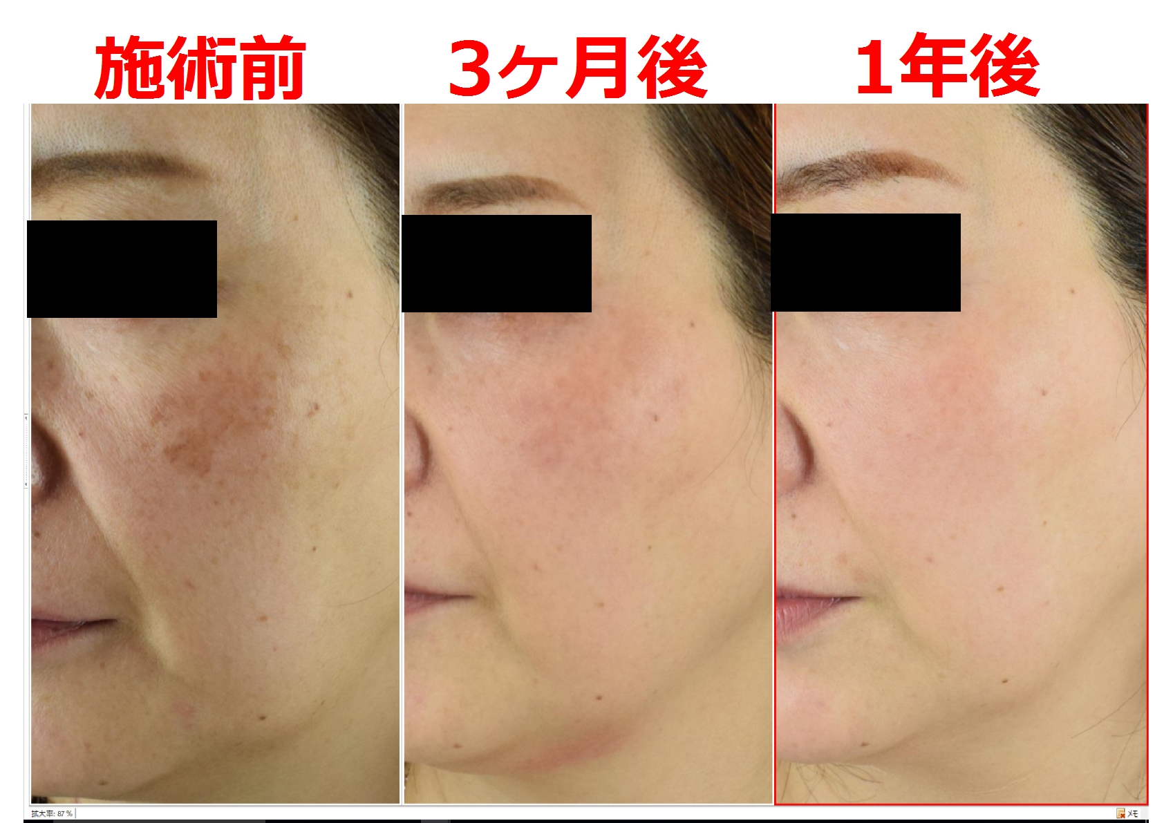 シミ取り放題 シミ治療みかこクリニック -Mikako Clinic- 形成外科 美容外科 美容皮膚科 一宮駅東口徒歩１分