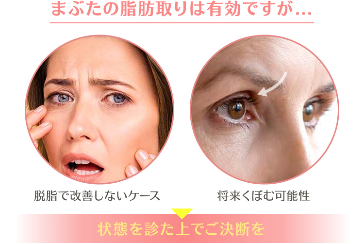 上まぶたの脂肪取りで腫れぼったさを解消：美容外科 高須クリニック