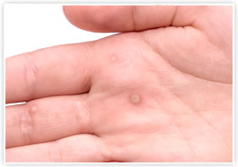 イボ取りは皮膚科でできる？人気のクリニックや口コミは