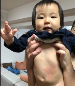 蕁麻疹の鍼灸 原因・定義・症状- 銀座そうぜん鍼灸院 深層筋・自律神経 銀座・築地