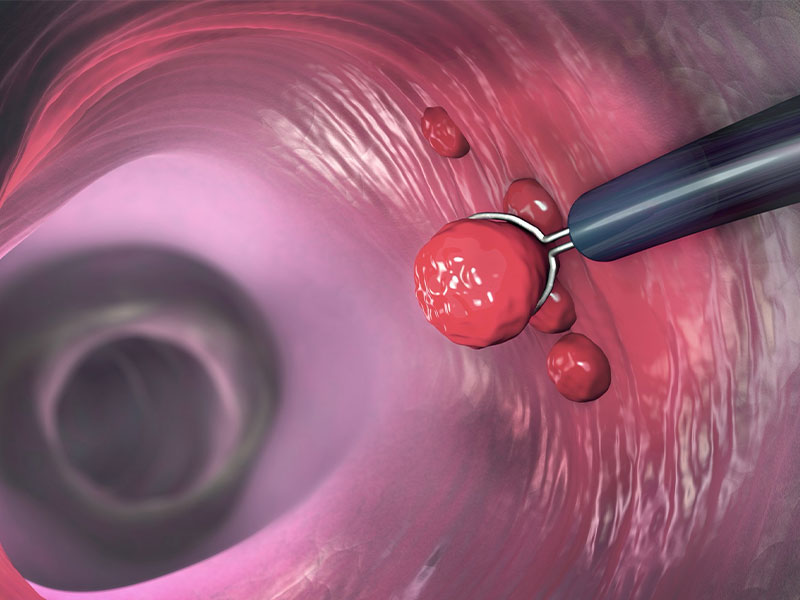 24時間以内に起こることが多い大腸ポリープ切除後の出血；出血した場合にはどうすればいいの