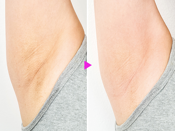 脇 ワキ に垢がたまる！？その対処法スキンケア大学