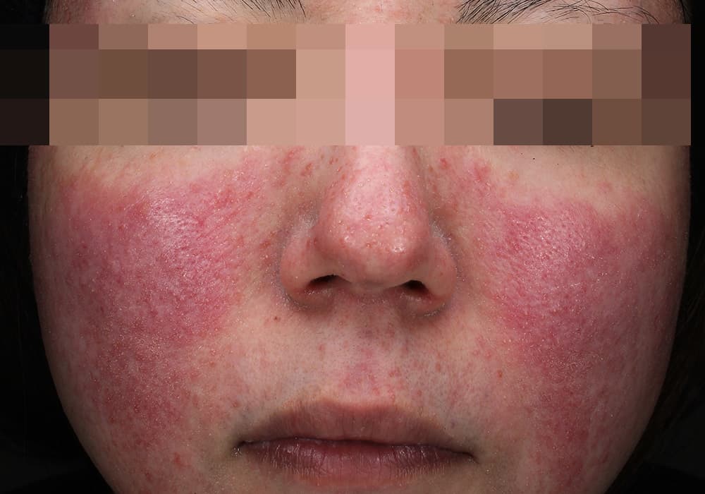 結節性紅斑の原因は感染症が多い - 医療法人信岡会 菊池中央病院