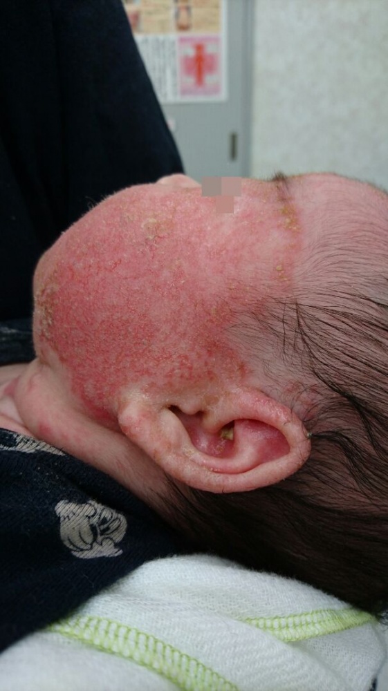 皮膚に白い皮むけ野田市 小児科 千葉県 こどもの花粉症 こどもの漢方 喘息 アトピー性皮膚炎 アレルギー 結節性痒疹 たんぽぽこどもクリニック