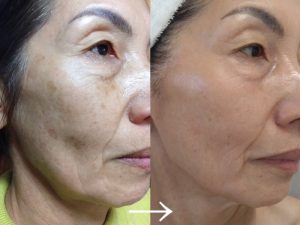 40代以上が選ぶ「これ受けて良かった！」美容医療 BEST3 - 京都院