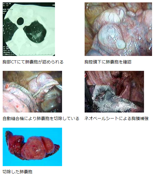 無気肺の種類や症状、検査、治療について - 日ノ出町呼吸器内科・内科クリニックブログ