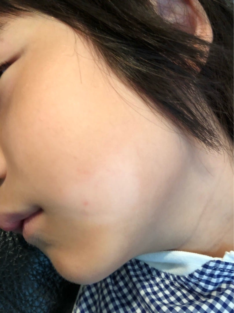 白斑？はたけ？ 5歳の冬転勤族、５人姉弟の生活