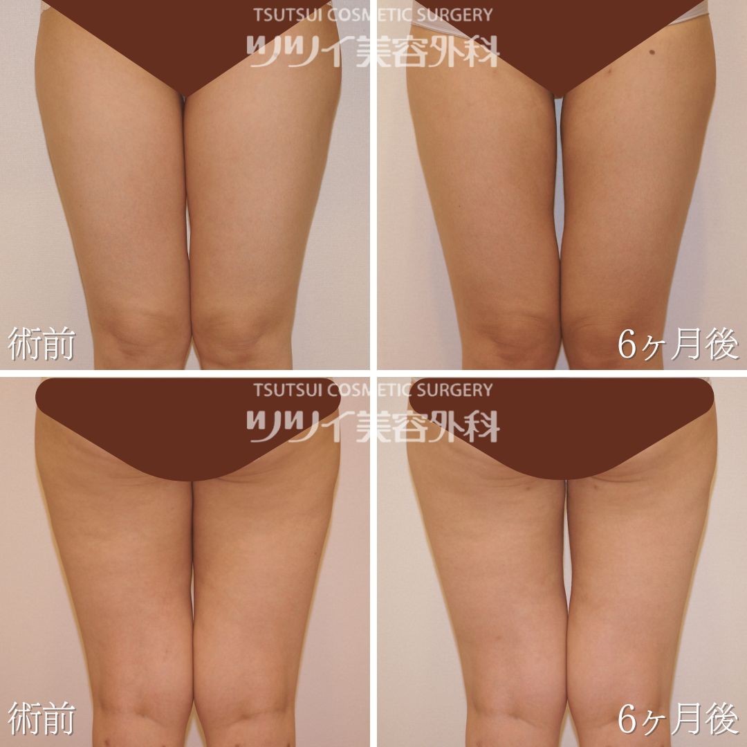 太ももの解剖学 – McDavidサポータ－ブランドのマクダビッド オフィシャルサイト