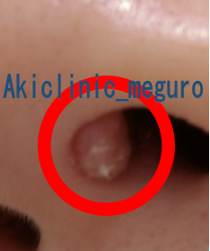 副鼻腔炎・蓄膿症・鼻茸の治療は横浜市都筑区のおおた耳鼻咽喉科へ