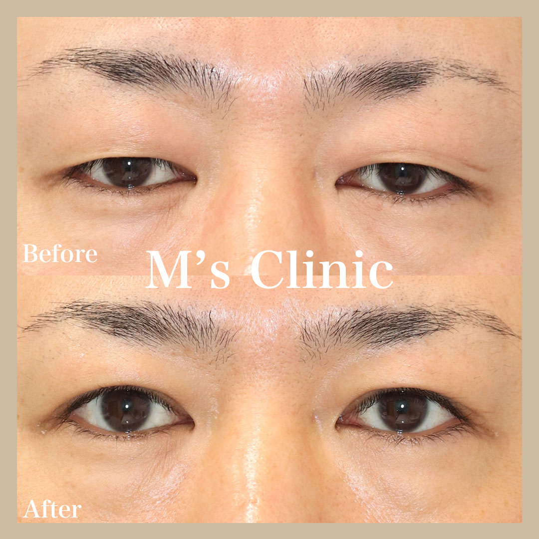 上まぶたの脱脂術 腫れぼったい目の改善奈良 樹のひかり形成外科・皮ふ科