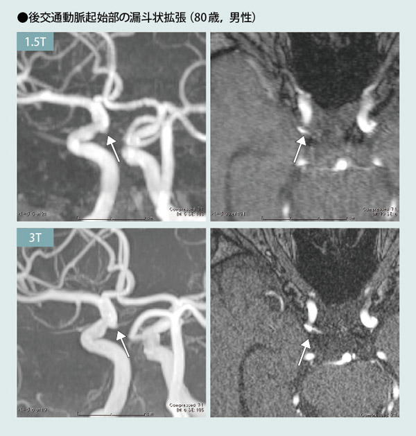 東京大学医学部脳神経外科：脳動脈瘤、くも膜下出血