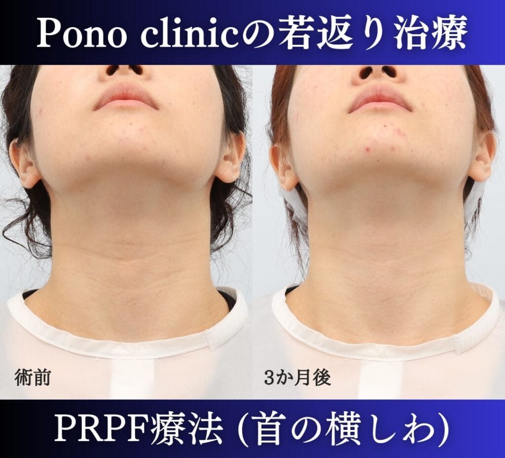 効果あり ニベア青缶クリームを顔に塗る「ニベアパック」を2週間試してみた結果 美容マニアの溺愛コスメ 美容メディアVOCE ヴォーチェ