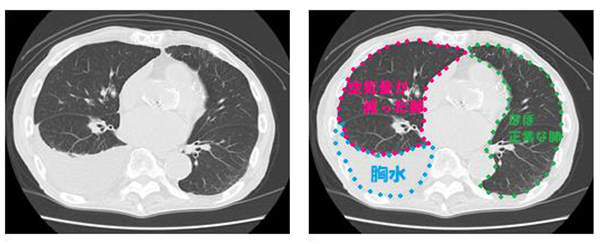 気胸について新座志木中央総合病院