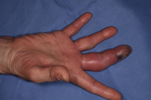 ひょう疽・爪周囲炎大田区大森・大木皮膚科 指の化膿でお困りなら