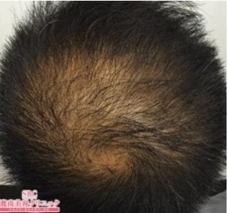 つむじのAGA・薄毛治療実績公式 ウィルAGAクリニック