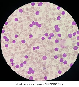 急性リンパ性白血病 急性リンパ芽球性白血病 リンパ芽球性リンパ腫 ： 国立がん研究センター がん情報サービス 一般の方へ